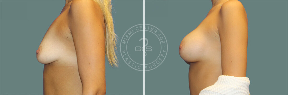 Breast Augmentation before and after photos in Miami Beach, FL, Patient 7355