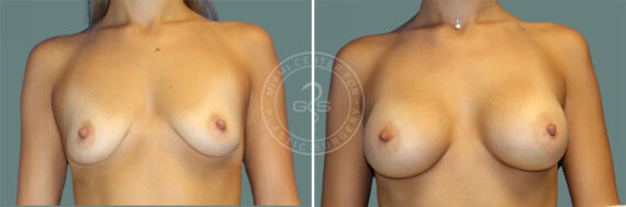 Breast Augmentation before and after photos in Miami Beach, FL, Patient 7355