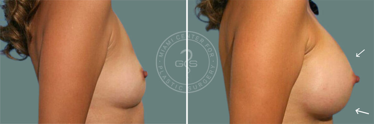 Breast Augmentation before and after photos in Miami Beach, FL, Patient 7371