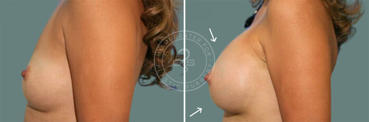 Breast Augmentation before and after photos in Miami Beach, FL, Patient 7371