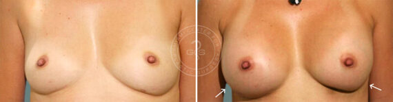 Breast Augmentation before and after photos in Miami Beach, FL, Patient 7371