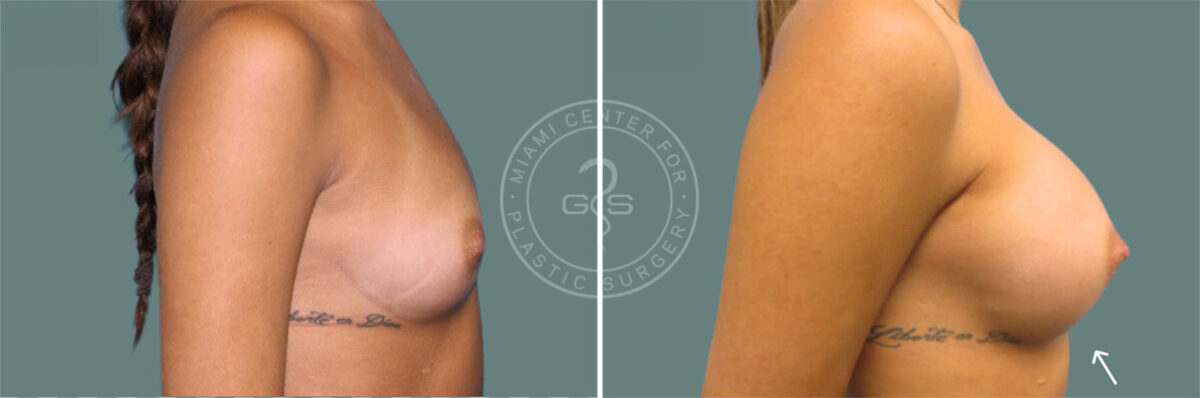 Breast Augmentation before and after photos in Miami Beach, FL, Patient 7381