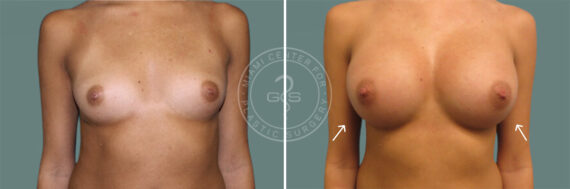 Breast Augmentation before and after photos in Miami Beach, FL, Patient 7381