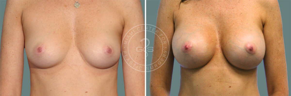 Breast Augmentation before and after photos in Miami Beach, FL, Patient 7388