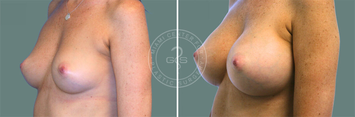 Breast Augmentation before and after photos in Miami Beach, FL, Patient 7388