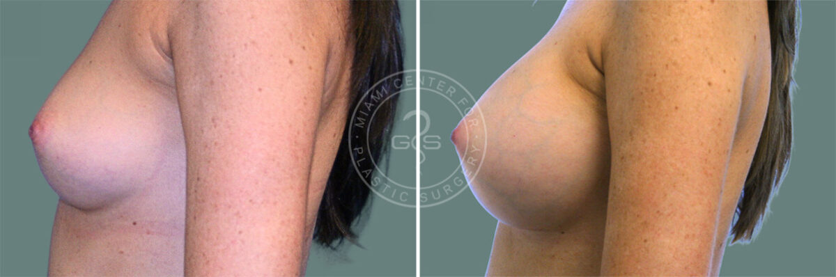 Breast Augmentation before and after photos in Miami Beach, FL, Patient 7388