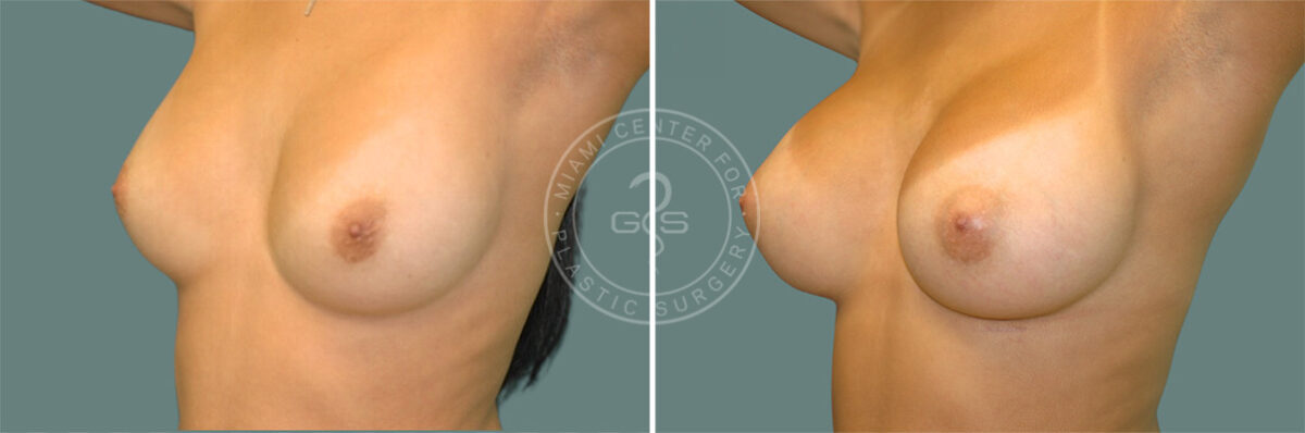 Breast Augmentation before and after photos in Miami Beach, FL, Patient 7401