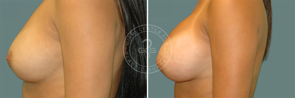 Breast Augmentation before and after photos in Miami Beach, FL, Patient 7401