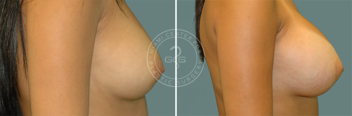 Breast Augmentation before and after photos in Miami Beach, FL, Patient 7401