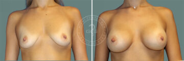 Breast Augmentation before and after photos in Miami Beach, FL, Patient 7645