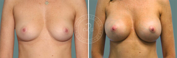 Breast Augmentation before and after photos in Miami Beach, FL, Patient 7685