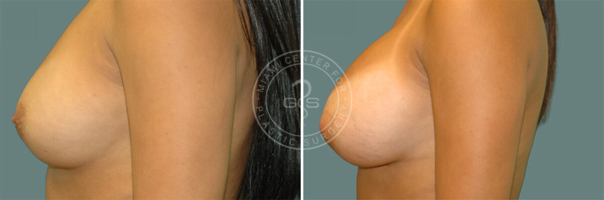 Breast Augmentation before and after photos in Miami Beach, FL, Patient 7698