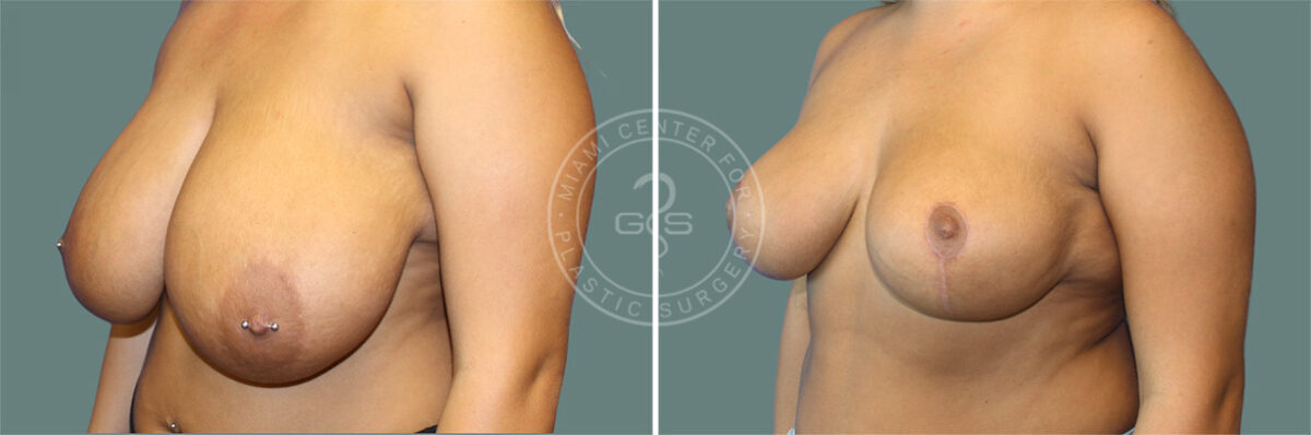 Breast Reduction before and after photos in Miami Beach, FL, Patient 8069