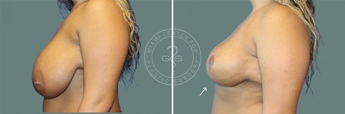 Breast Reduction before and after photos in Miami Beach, FL, Patient 8069