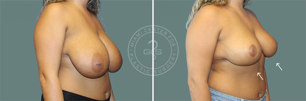 Breast Reduction before and after photos in Miami Beach, FL, Patient 8069