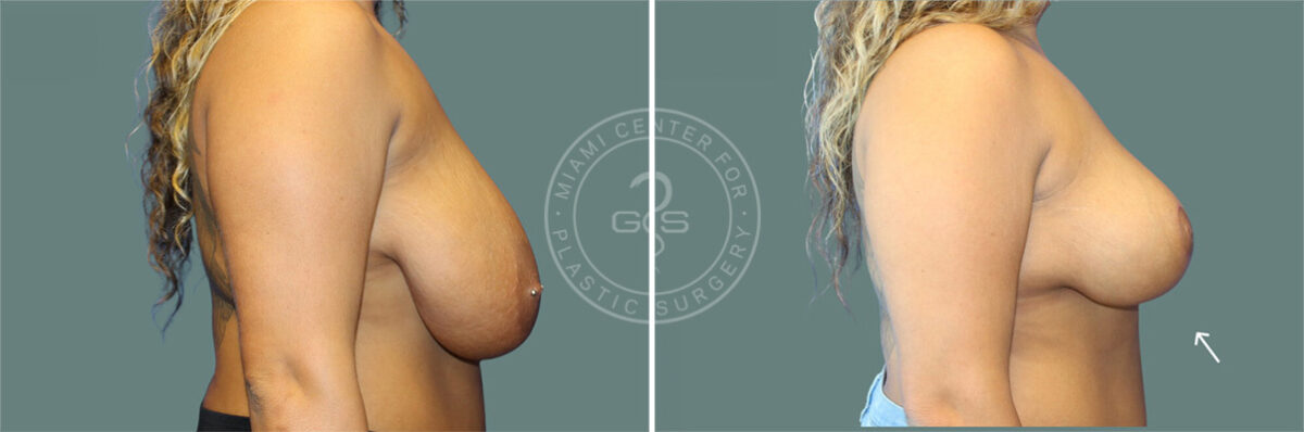 Breast Reduction before and after photos in Miami Beach, FL, Patient 8069