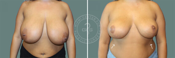 Breast Reduction before and after photos in Miami Beach, FL, Patient 8069