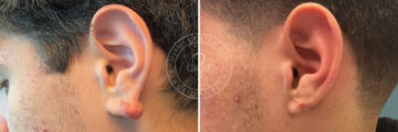 Keloid Removal before and after photos in Miami Beach, FL, Patient 8286