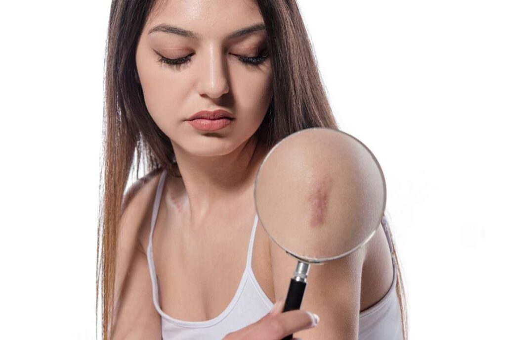 Woman examining a keloid scar on her arm with a magnifying glass, showing its texture and color differences.