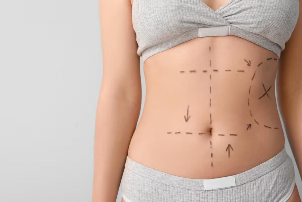 Close-up of a marked abdomen showing targeted areas for liposuction techniques like tumescent and assisted methods.