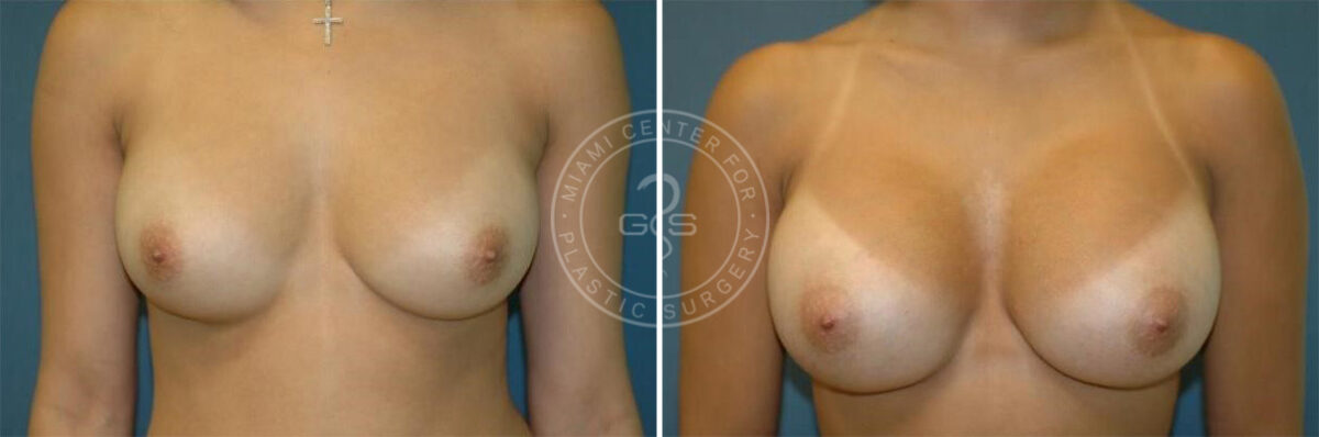 Breast Augmentation before and after photos in Miami Beach, FL, Patient 2638