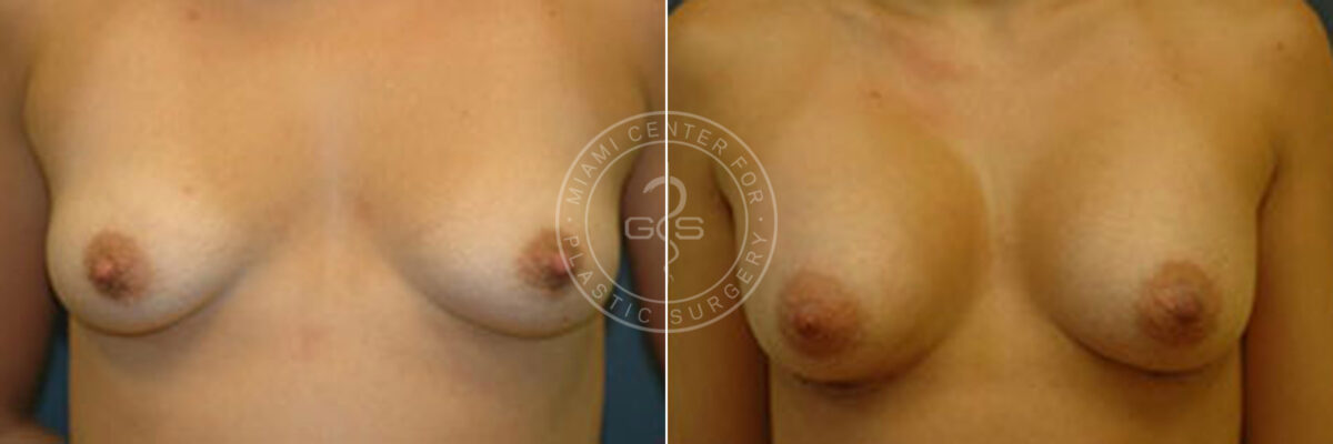 Breast Augmentation before and after photos in Miami Beach, FL, Patient 2713