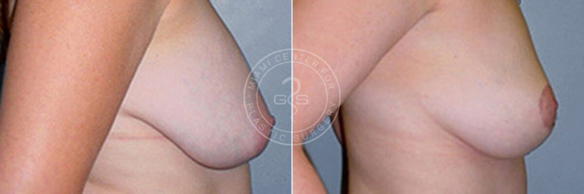 Breast Lift before and after photos in Miami Beach, FL, Patient 2821