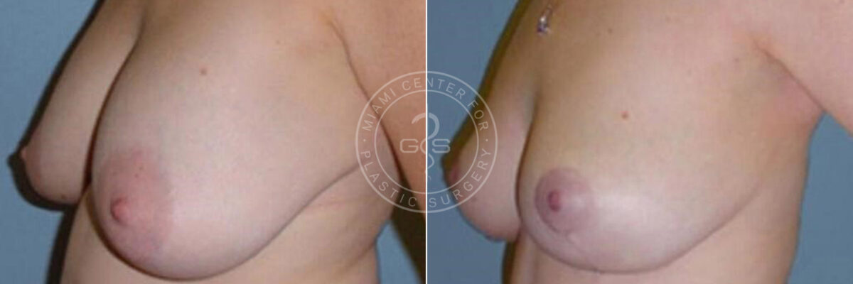 Breast Lift before and after photos in Miami Beach, FL, Patient 2821