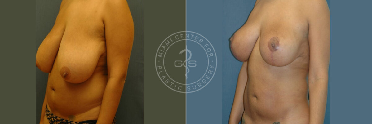 Body Sculpting before and after photos in Miami Beach, FL, Patient 2963