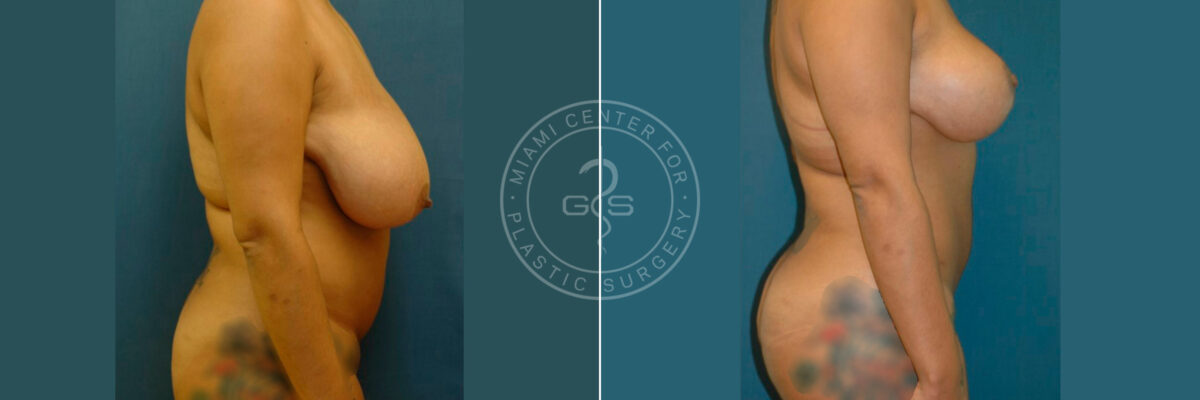 Body Sculpting before and after photos in Miami Beach, FL, Patient 2963