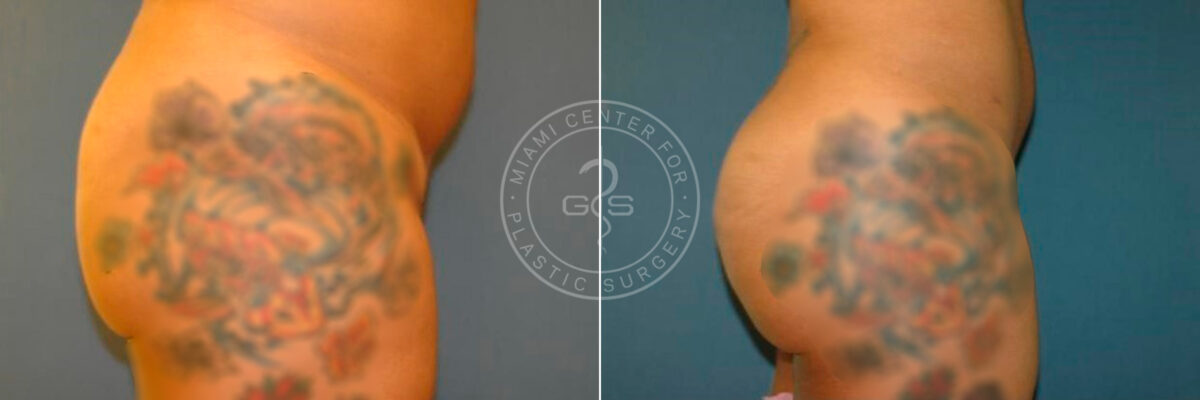 Body Sculpting before and after photos in Miami Beach, FL, Patient 2963