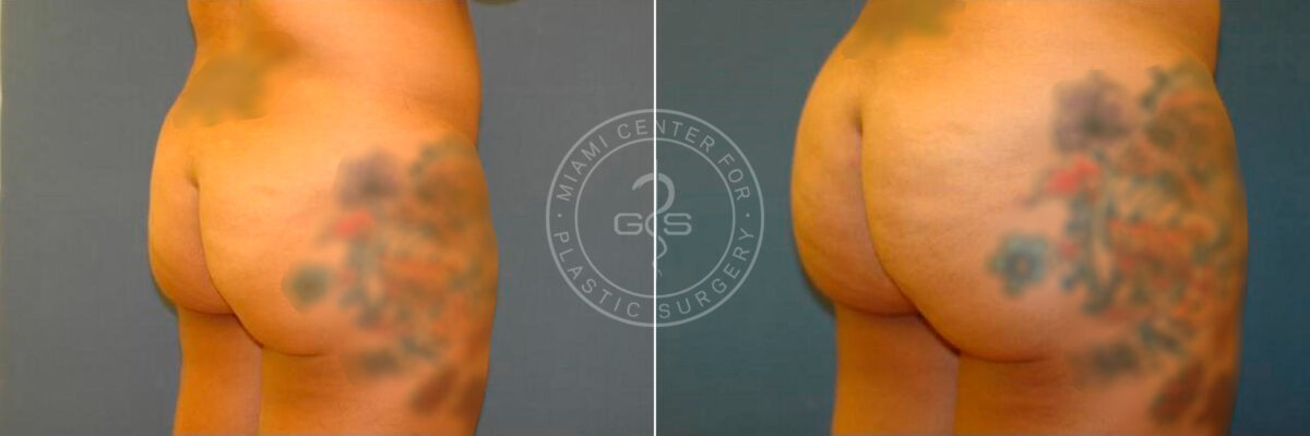 Body Sculpting before and after photos in Miami Beach, FL, Patient 2963