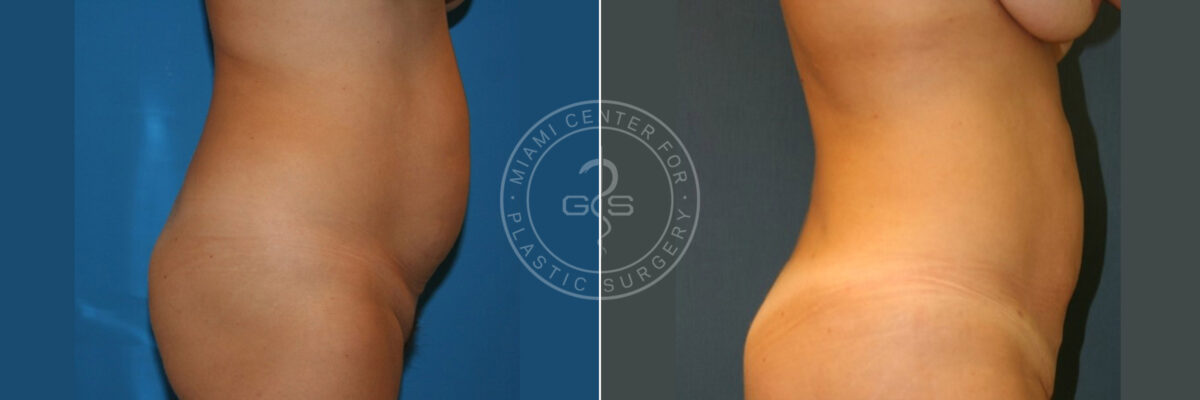 Body Sculpting before and after photos in Miami Beach, FL, Patient 2985