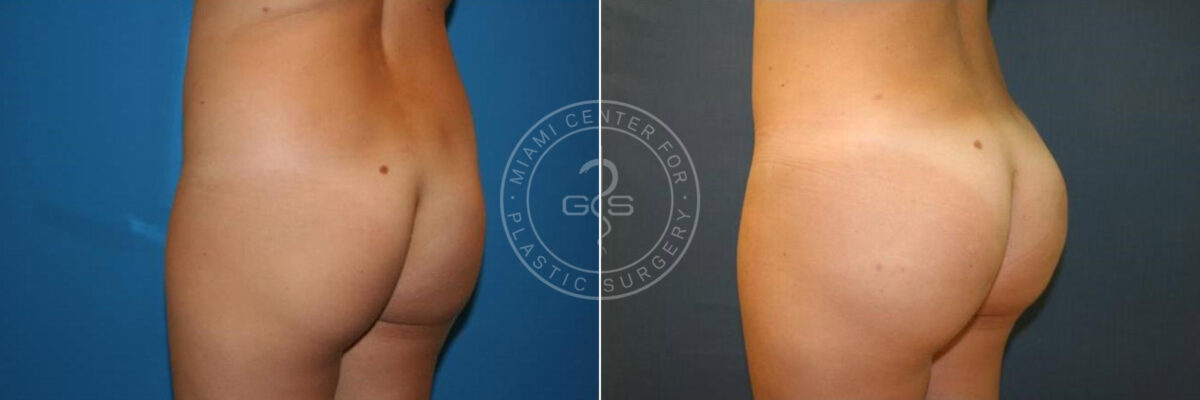 Body Sculpting before and after photos in Miami Beach, FL, Patient 2985