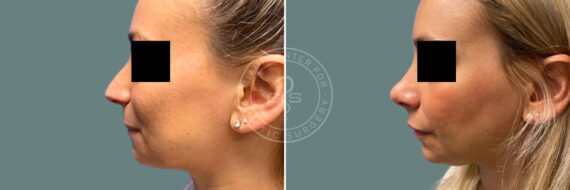 Rhinoplasty before and after photos in Miami Beach, FL, Patient 8812