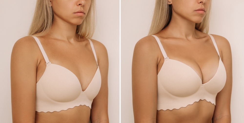Side-by-side comparison of woman before and after breast augmentation showing enhanced size and shape in nude bra.