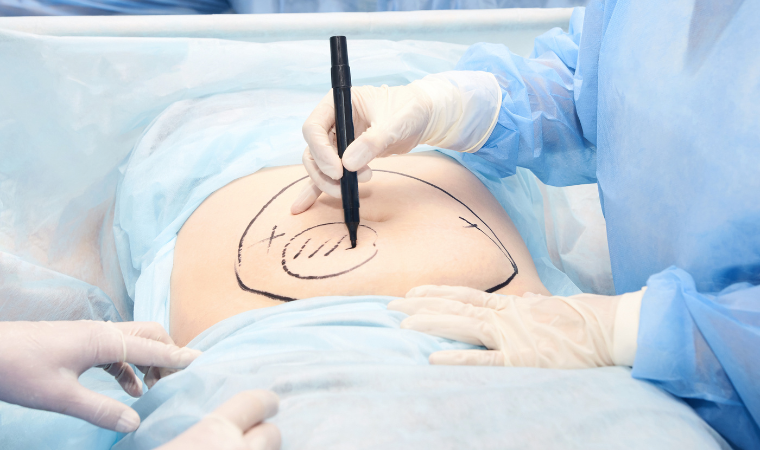 HD liposuction coral gables