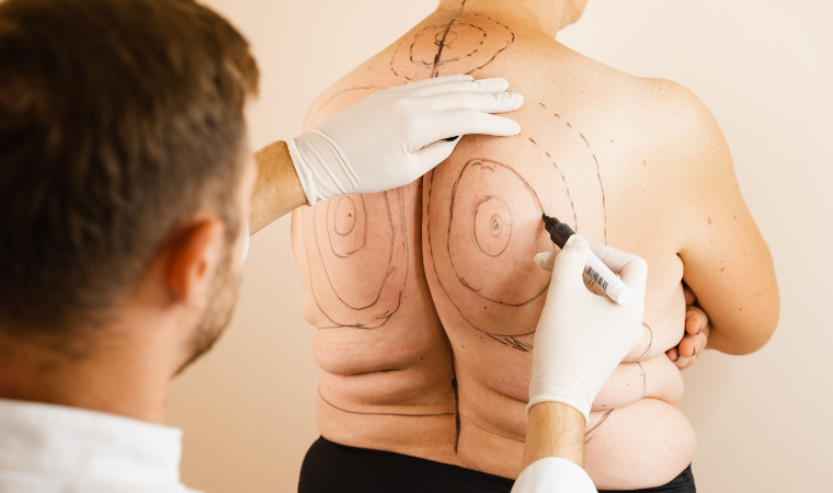 liposuction in brownsville