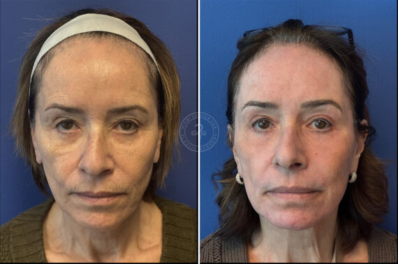 Laser Treatment before and after photos in Miami Beach, FL, Patient 9862